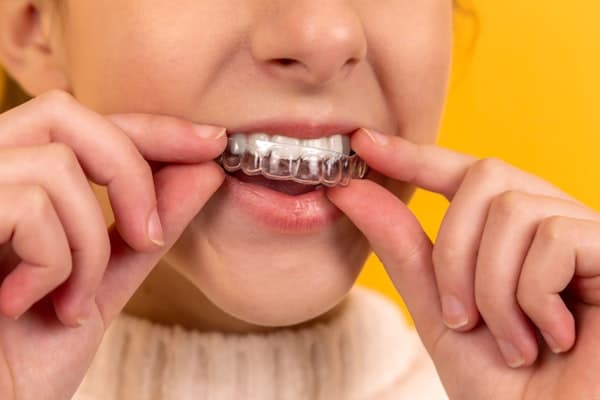 Teeth before Invisalign treatment