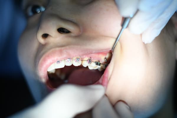 Teeth before Invisalign treatment
